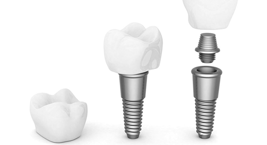 implantes-dentales buenos aires