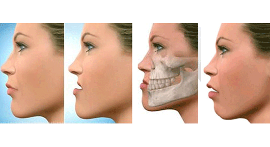 Prognatismo Mandibular o Clase 3 » Cirugía Ortognática - Instituto