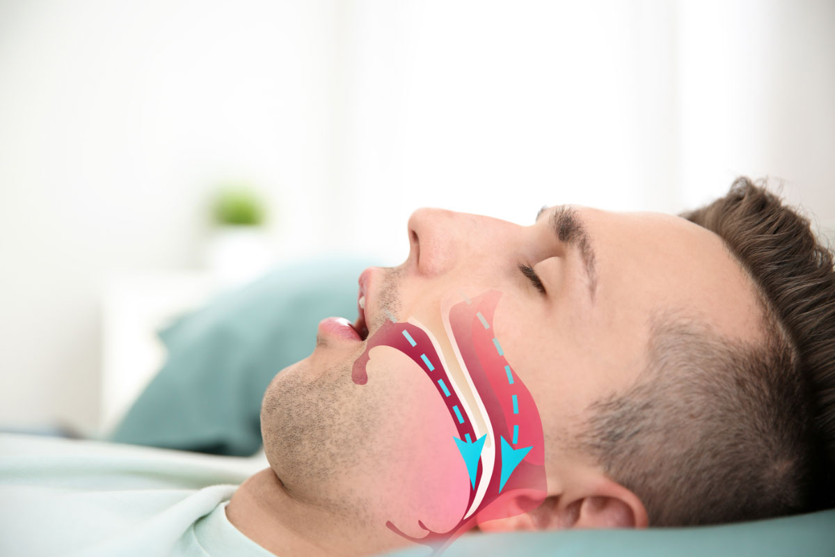 apnea del sueño y cirugia ortognatica